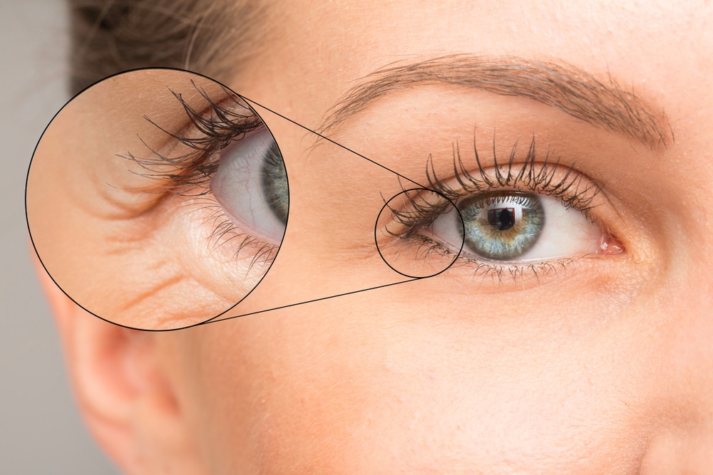 Eyelid Surgery 